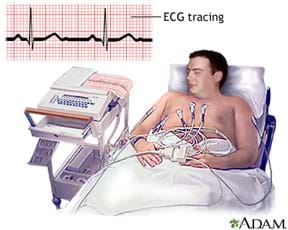 A drawing shows a man reclining in a bed with electrodes on his bare chest connected to a device near the bed. A line drawing shows the familiar blips of an electrocardiogram (heartbeat)&mdash;an ECG tracing. 
