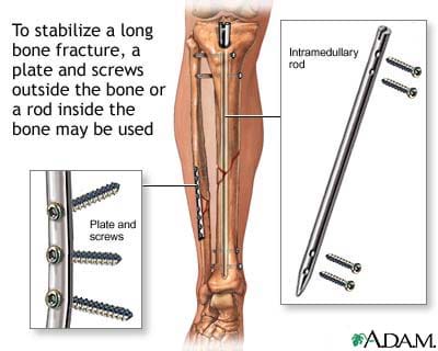 Cutaway medical illustration shows repaired fibula and tibia with plate and screws, and intramedullary rod and screws.