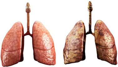 Two photos: healthy lung (left) and contaminated lung (right).