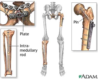 Drawing shows a human skeleton of pelvis, legs and feet with three locations containing bone repair using a pin, plate and intramedullary rod.