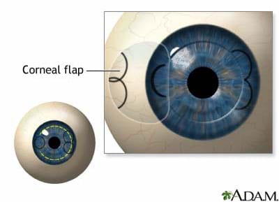Diagram looking at an eyeball, shows a still-attached clear tissue opened to the side of the iris.
