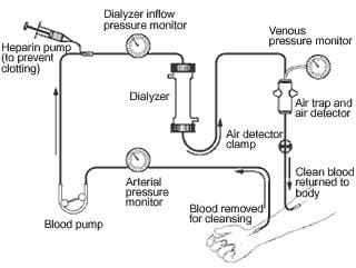 A schematic drawing of the overall dialysis system, showing the steps of dialysis, including: blood being removed from a person's arm, running through the dialyzer, and the clean blood being returned to their arm.