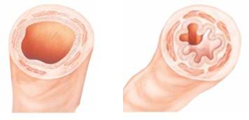 Drawing of a normal bronchus on the left compared to an asthmatic bronchus on the right.