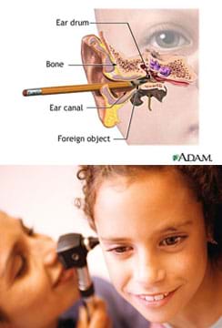 A cutaway medical illustration shows the pointed end of a pencil in a child's ear, lodged into the ear canal all the way to the ear drum. A photo shows a woman using a handheld device to look into a girl's ear.