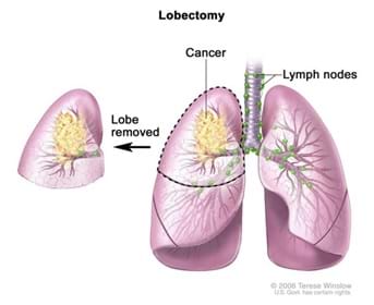 A medical drawing shows a set of lungs with a cancerous tumor. The top half of the left lung has been removed, demonstrating a lobectomy.