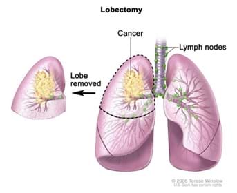 A medical drawing shows a set of lungs with a cancerous tumor. The top half of the left lung has been removed, demonstrating a lobectomy.