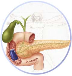 A medical illustration shows a thumb-sized blue device inside the duodenum at a location where an oblong growth is attached to the gastrointestinal wall.