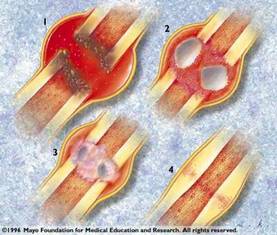 Four cut-away drawings show a broken bone that morphs into a bridged and then fully-healed bone.