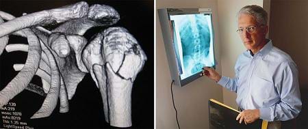 Two photos: (left) 3-D black and white image of upper arm and shoulder shows fractures in top of humerus bone, (right) a man standing by a wall-mounted light box that displays an x-ray of a human spine.