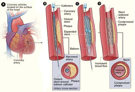 Cut-away diagram shows an expanding balloon and metal mesh stent, entering, pushing out on the walls, and leaving the stent in an artery.