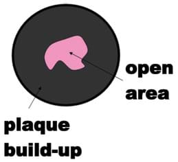 Cross-section diagram shows only a small, irregular passageway through thick walls.