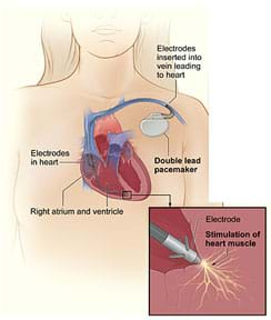 A drawing shows a cross-section of a person's chest with a pacemaker with wires with electrodes inserted into the right atrium and ventricle of the heart through a vein in the upper chest. A detail drawing shows the electrode electrically stimulating the heart muscle.