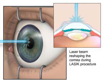 Drawing shows a laser beam focused on an eye pupil, with eye held open with metal prongs. Cross-section diagram shows a laser beam creating a flatter area on a curved arc. 