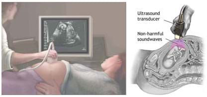 (left) A drawing shows a pregnant woman lying on a table with a technician holding a device on her belly, both looking at the resulting black and white images appearing on a nearby computer screen. (right) A cross-section drawing of a female abdomen shows how non-harmful sound waves from the ultrasound transducer travel through the body and bounce back from dense structures like the fetus and uterus wall, translating to a visual image by a computer.