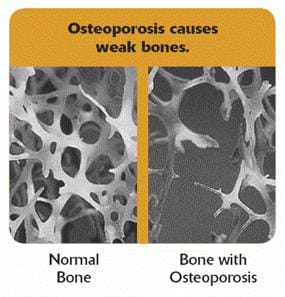A x-ray type photograph of normal bone and a bone with osteoporosis. The heading reads: "Osteoporosis causes weak bones." 