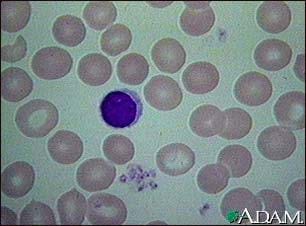 A microscopic image of normal red blood cells.