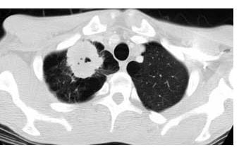 Image of the lungs (black masses) where the right lung (left side of image) has cancer (white mass).