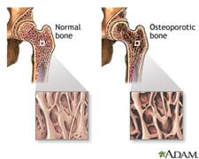 A medical drawing shows the cross sections of two bones. The normal (healthy) bone cross-section shows a mass of strand-like material. The osteoporotic bone cross section is less dense and contains many holes and gaps between the strand material.