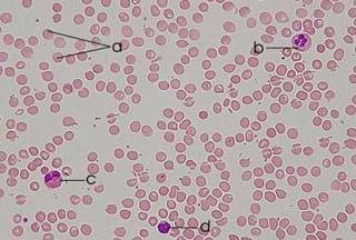 A microscopic blood smear photograph shows pale reddish dots scattered on a pale purple background.