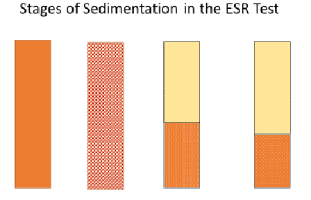 Diseases Exposed: ESR Test in the Classroom - Activity