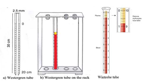 A diagram shows four images of ESR tubes, two Westerngren tubes and two Wintrobe tubes. From left to right: a) An empty 2-ml Westerngren tube shows graduation marks and dimensions of 30 cm tall by 2.5 mm diameter. The lower 20 cm are marked from 0 at the top to 20 at the bottom. A Westerngren tube with a sample of blood left to stand on a rack shows erythrocytes settling and the plasma clarifying. b) A Wintrobe tube filled with blood shows erythrocytes settling and the plasma clarifying at the top. This 1-ml glass tube is narrow, closed at the lower end and only 11 cm tall by 2.5 mm internal diameter. (right) A magnified view of the top portion of the just-described Wintrobe tube, the portion containing the clear plasma, shows the markings that enable an ESR reading of the distance the erythrocytes have fallen.