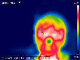 An infrared thermography (IRT) image of a human face shows a range of colors that indicate temperatures ranging from 73.9 to 93.9 °F. The eyes and immediately surrounding area are white—the highest face temperature. The brow, cheeks and chin are red—the next highest temperature. Beyond the cheeks and forehead, the face and head are orange and yellow—even cooler temperatures. The nose tip and top of the head are green and blue—the lowest temperatures on the face.