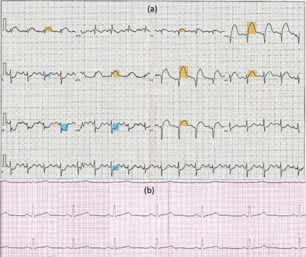 The ECG of an arrhythmic heart and the ECG of a healthy heart.