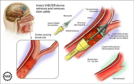 A diagram with medical images shows a stroke-causing blood clot and how the Insera SHELTER device retrieves and removes blood clots safely by inserting a long, narrow, pointed device into a human brain's blood vessel. The device is made of nickel and titanium with a chemical electropolish coated with polymer (will not pierce vessel) and a microwire tip, and is folded for insertion. Vessel sizes: 1.5–4.5 mm. The tip penetrates the clot easily. Laser-drilled holes let good blood cells through, but no debris. 