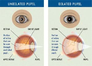 Medical diagram shows dilated and undilated eye pupils in front and side views.