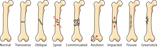 A drawing shows a normal long-shaped bone and eight similar bones, each with markings indicating different types of fractures: transverse, oblique, spiral, comminuated, avulsion, impacted, fissure, greenstick.