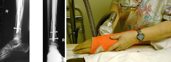 Two photographs. An x-ray shows two views of a person's right foot, ankle and shin (distal portion of a fractured tibia) with an internal rod and screws in place. A person uses a hand-sized saw to cut through the rigid cast on another person's right hand arm from mid palm to forearm.