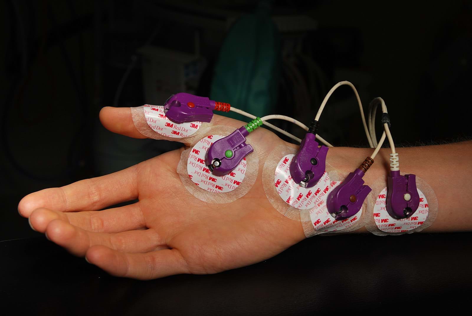 A photo of a hand with medical sensors attached to the thumb, palm, and wrist. Wires from the sensors lead to a medical device.  