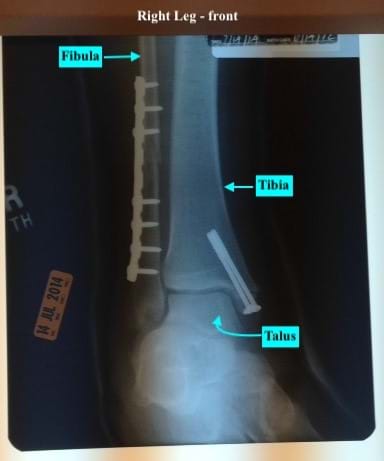 X-ray of leg bones post-surgery. The fibula has 7 screws inserted to hold it together. The tibia has 2 longer screws.