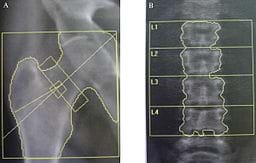 Two black and white x-ray images. A dual-energy x-ray absorptiometry (DEXA) assessment of bone mineral density of the femoral neck (A) and the lumbar spine (B): T scores of - 4.2 and - 4.3 were found at the hip (A) and lumbar spine (B), respectively in a 53 year-old male patient affected with Fabry disease.
