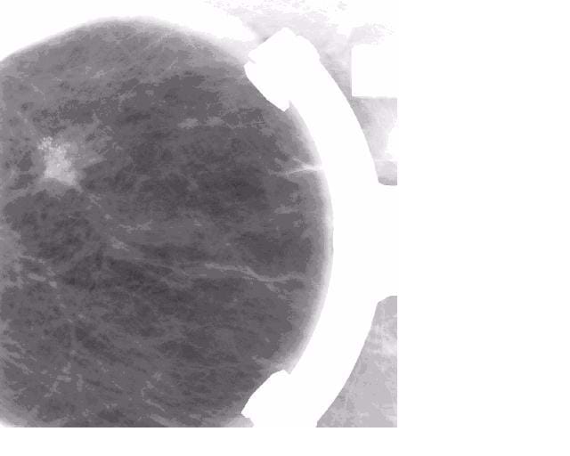 A mammogram image showing a tumor. Provided by Vanderbilt University Radiology Department.
