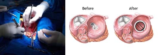 Two images: Photo shows open heart surgery being performed. Medical illustration of a cross section of a normal heart and a cross section of a heart with an artificial valve in place.