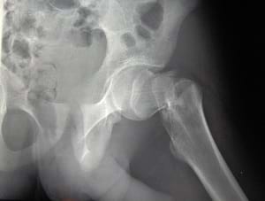 An X-ray of a woman's fractured hip.