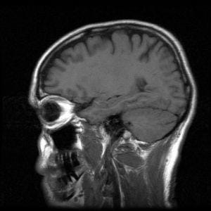 A black and white image shows a side-view x-ray of a person's skull.
