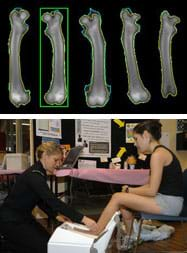 Two images: An x-ray image shows five different angles of a long bone taken for a bone density medical scan. A photograph shows a woman performing a bone density test by placing the foot of a nearby seated woman into a box-shaped machine on the floor.