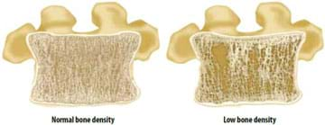 A drawing shows the cross-section of two bones, comparing normal bone density to low bone density; fewer fibers and structures are shown in latter drawing.