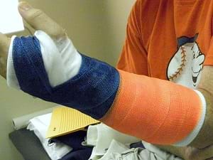 A man's broken arm placed in a blue and orange cast.